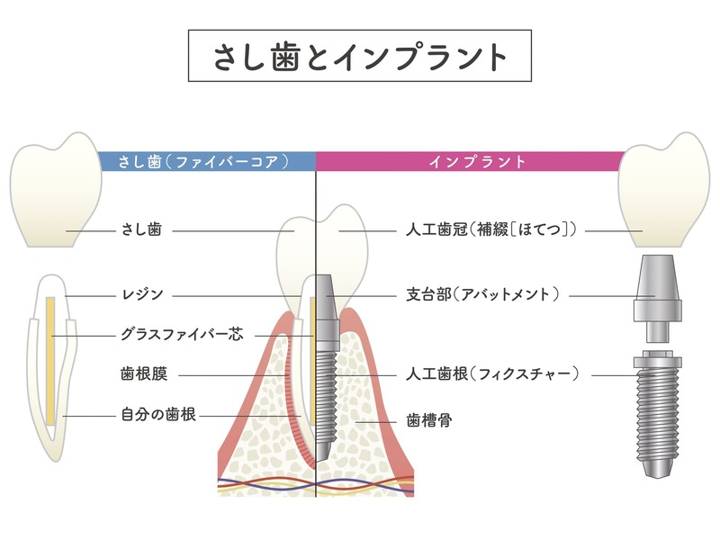 インプラントとは？