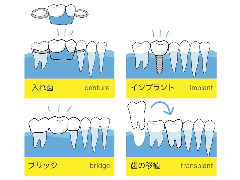 インプラントとは？