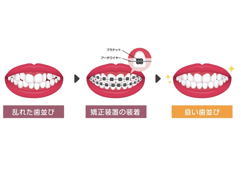 子どものための歯科矯正