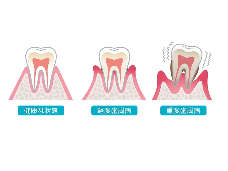 歯周病ってなに？歯肉炎と歯周炎の違いや原因について解説