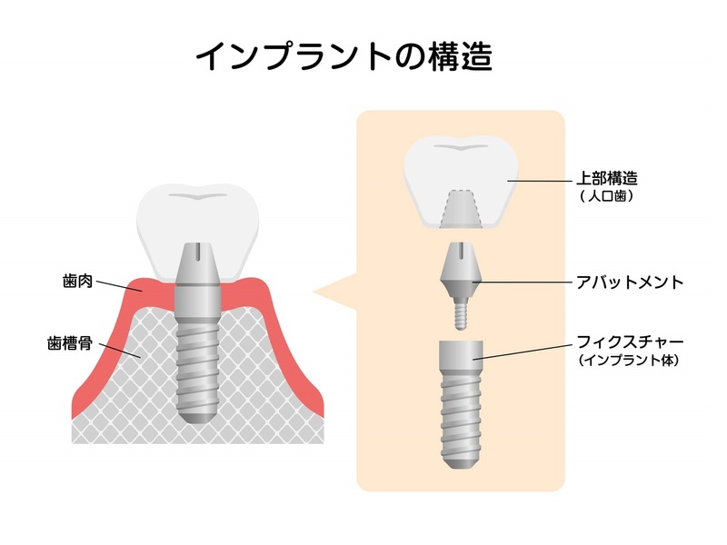 インプラント治療はどのくらいの期間がかかる？